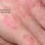 Dermatitis Atópica